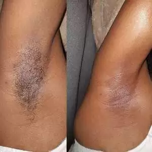 Collage of a client's armpit with and without hair after sugar waxing hair removal service at the client's home in Nairobi